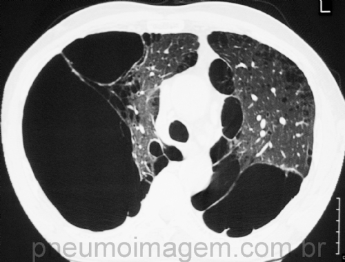 MAIOR RISCO CARD�ACO COM O IN�CIO DO USO DE BRONCODILATADOR DE A��O PROLONGADA